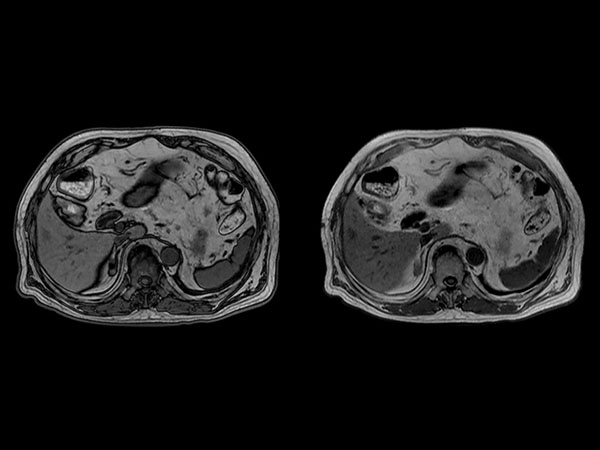 Axial T1w in/out phase